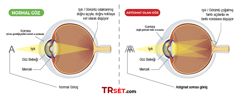 astigmatlı göz astigmatizm png