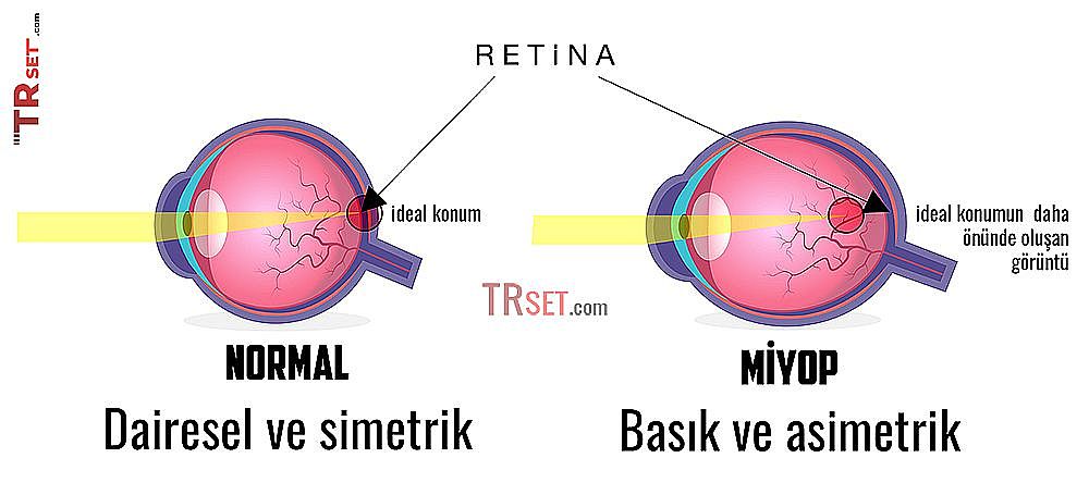 myopia