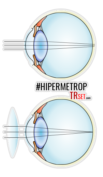 hipermetrop