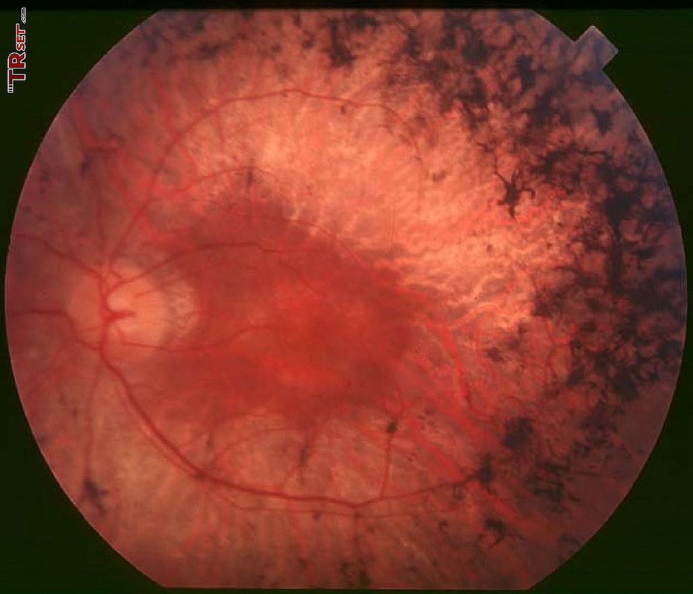 retinitis pigmentosa