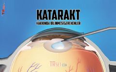 Katarakt Nedir? Nasıl Tedavi Edilir?